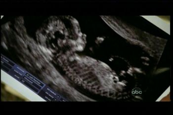 Sonogram photo of Valerie's baby